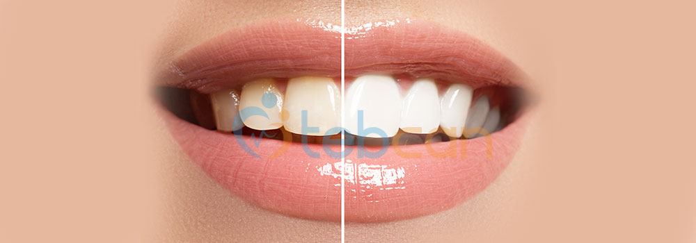 Veneers vs. Crowns: What Are the Pros and Cons of Each?